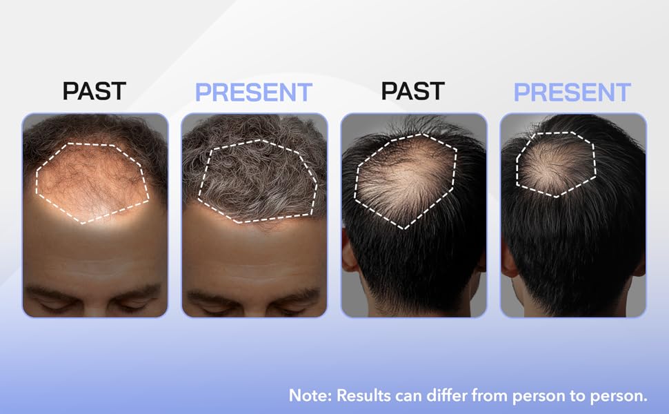 Red Light Therapy Hair Growth Cap - Stop 100% Hair Fall Reduction - Advance Laser Cap for Hair Growth - For Men & Women