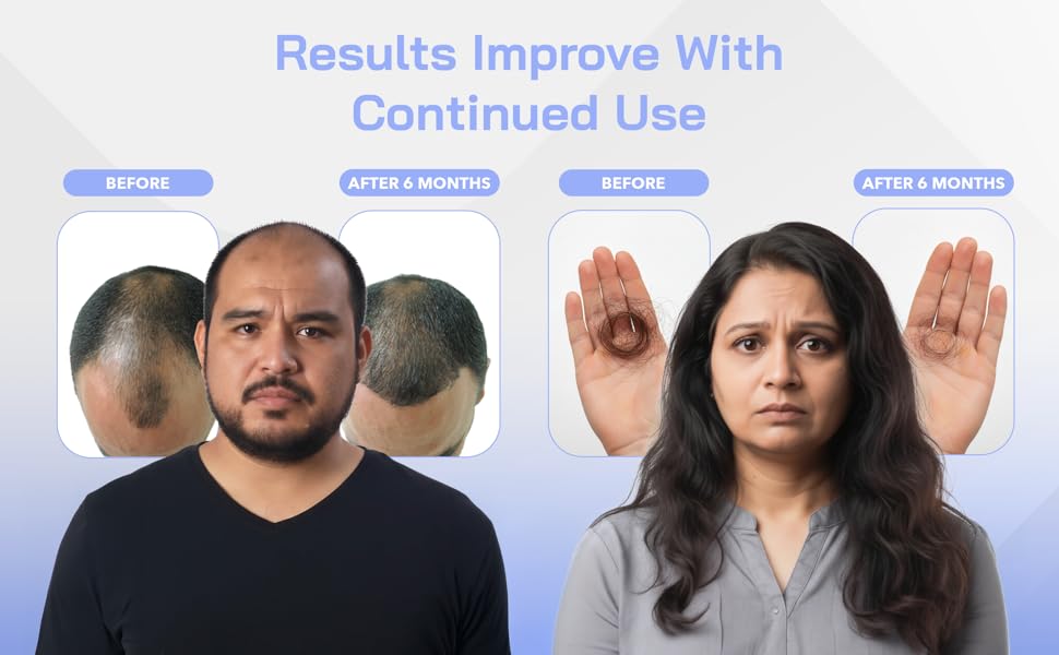 Red Light Therapy Hair Growth Cap - Stop 100% Hair Fall Reduction - Advance Laser Cap for Hair Growth - For Men & Women